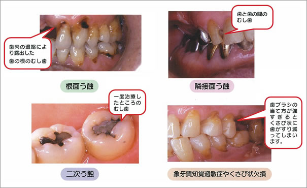 成人のむし歯の特徴