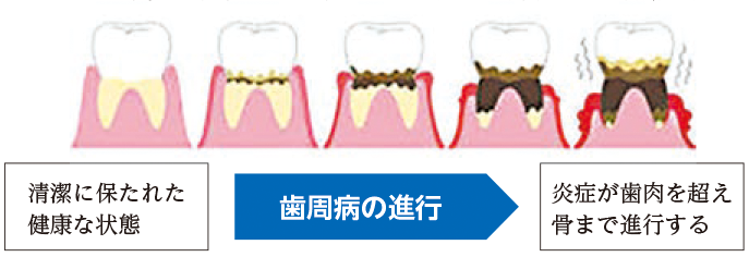 歯周病の進行